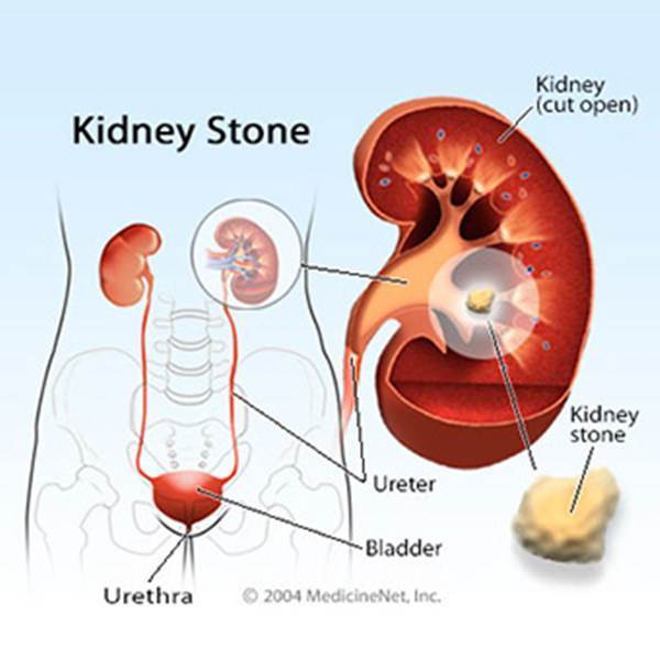 Factors that contribute to kidney disease Factors that contribute to kidney disease